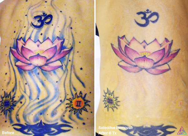 Before and after tattoo removal